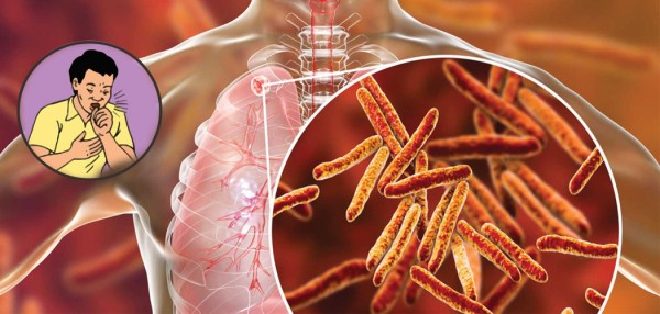 स्याङ्जामा एक सय ६० क्षयरोगी उपचारमा, पाँच जनाको मृत्यु